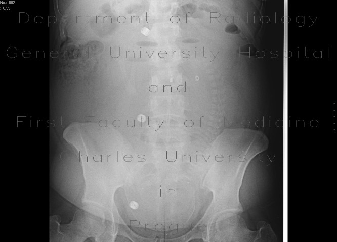 Radiology image - Gravidity: Abdomen, Gynecology: X-ray - Plain radiograph