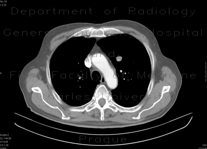 Radiology image - Grawitz tumor, renal cell carcinoma, metastatic disease: Abdomen, Thorax, Kidney and adrenals, Liver, Lung: CT - Computed tomography