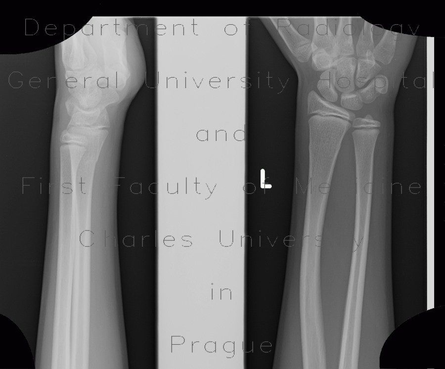 Greenstick fracture of radius