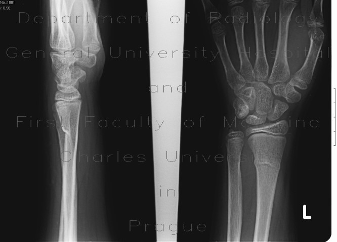 greenstick fracture x ray