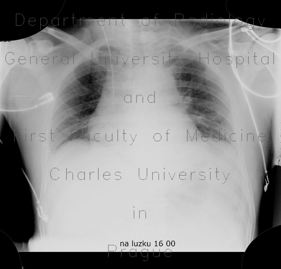 Guide wire in superior vena cava, forgotten