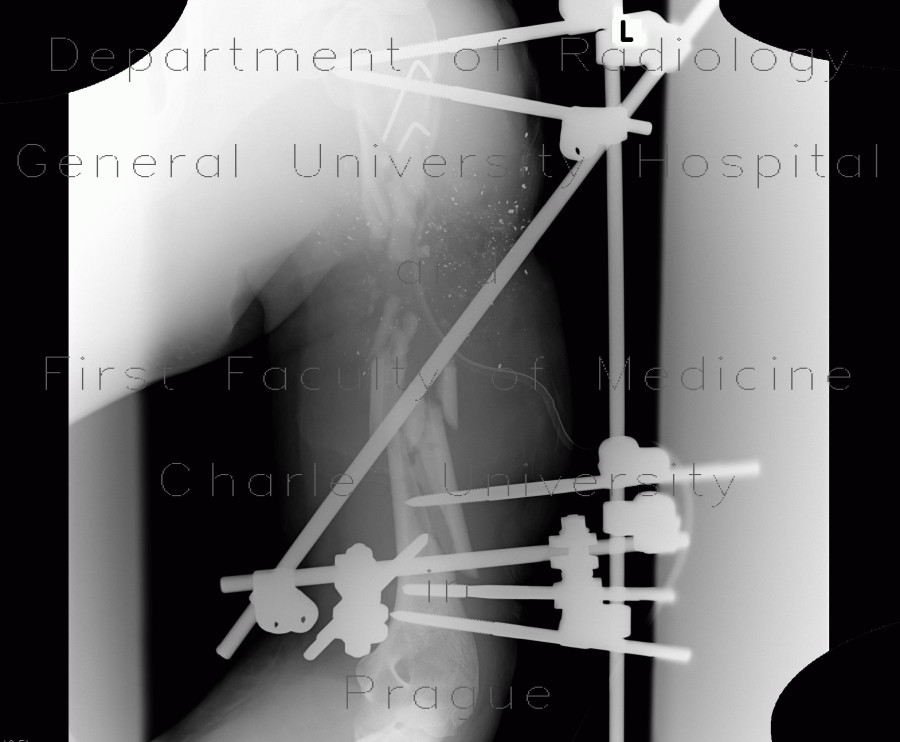 Gunshot wound of humerus, osteosynthesis