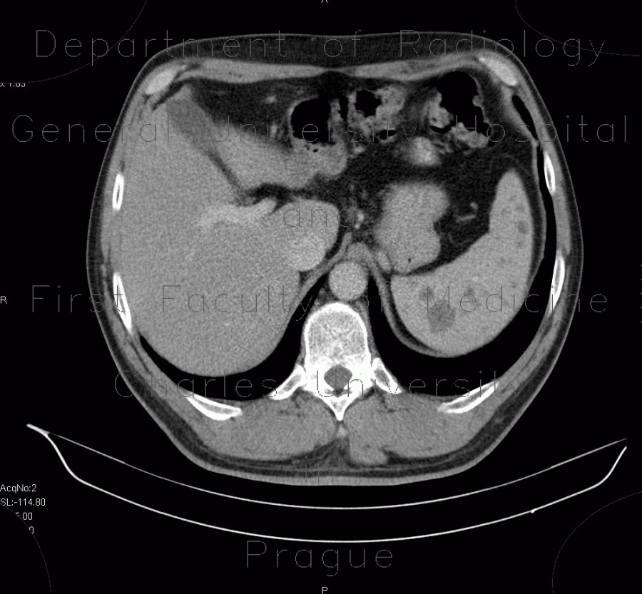 Radiology image - Hamartomas of spleen, hamartoma: Abdomen, Lymphatic: CT - Computed tomography