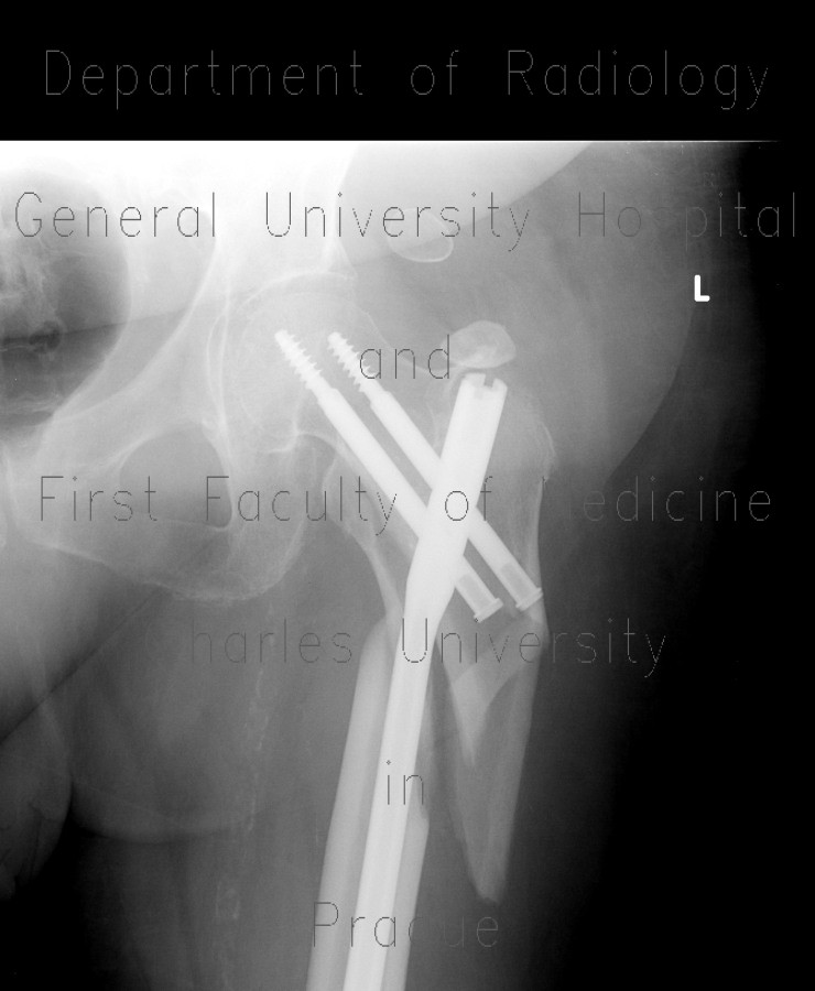 Hardware failure, dislocation, PFN, proximal femoral nail, calcification in gluteus muscle after injection