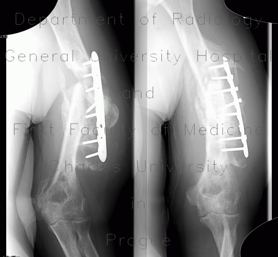 Hardware failure, osteosynthesis, deformity, fracture of humerus