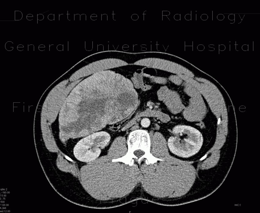 Hemangioma