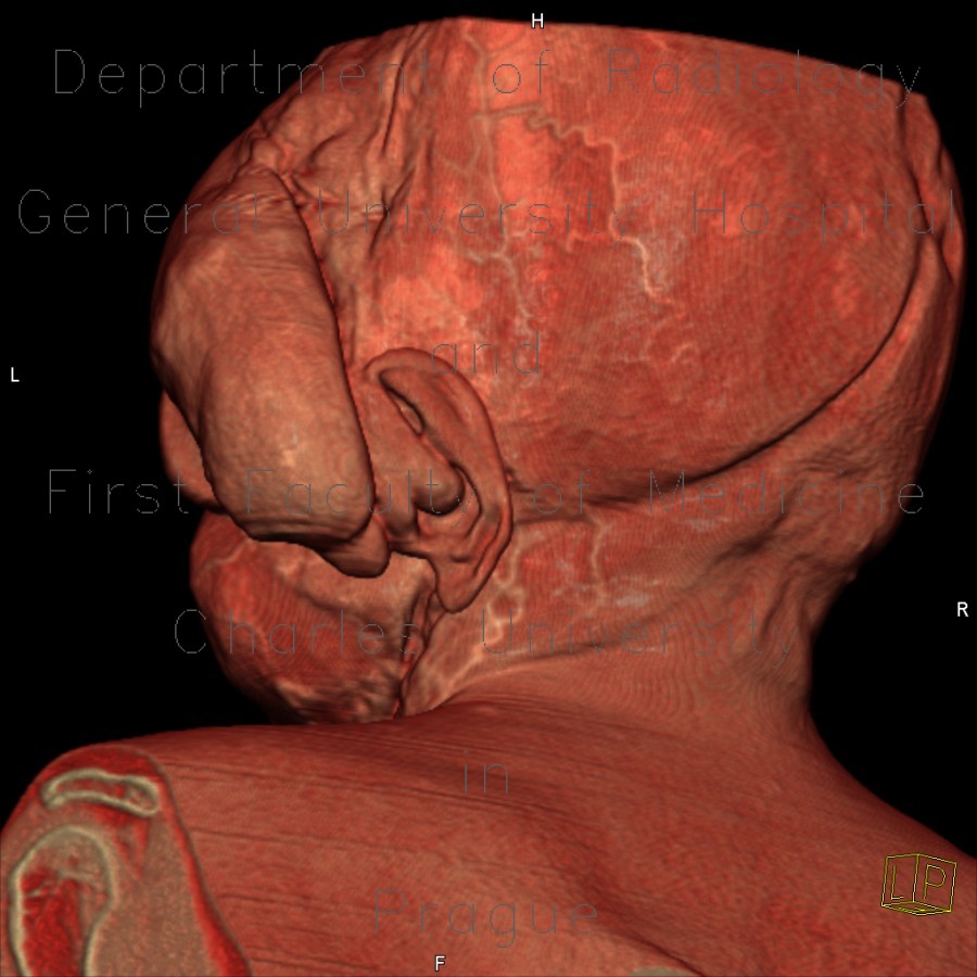 Hemangioma of face, extensive