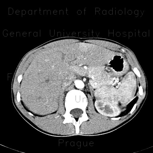 Radiology image - Hemangioma of liver, large: Abdomen, Liver: CT - Computed tomography