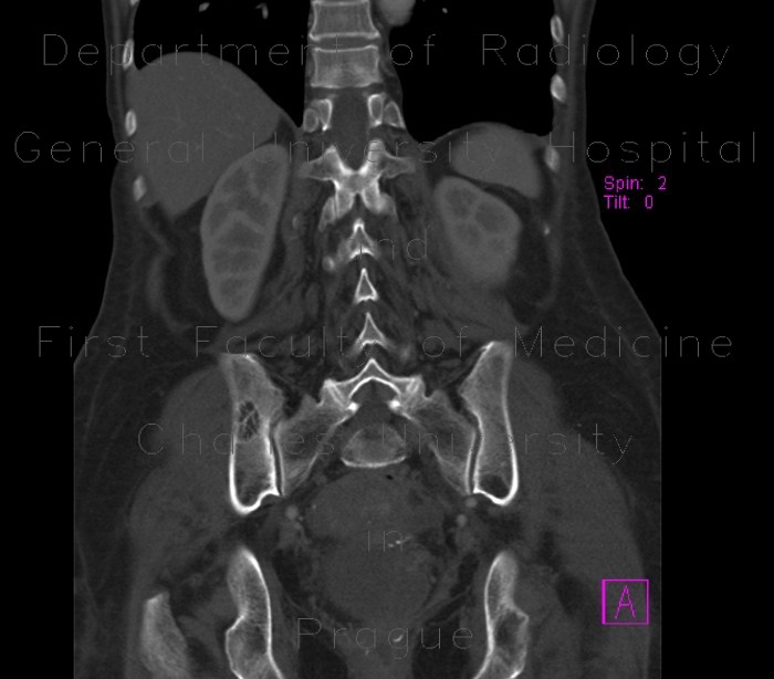 Radiology image - Hemangioma of pelvis and vertebra: Spine and Axial, Bone: CT - Computed tomography