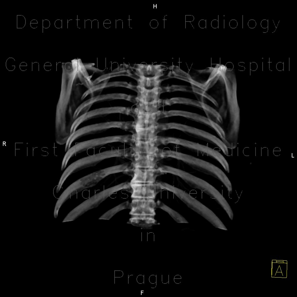 Radiology image - Hemangioma of rib: Thorax, Bone: CT - Computed tomography