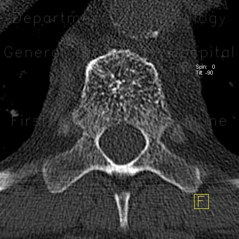 Hemangioma of vertebral body