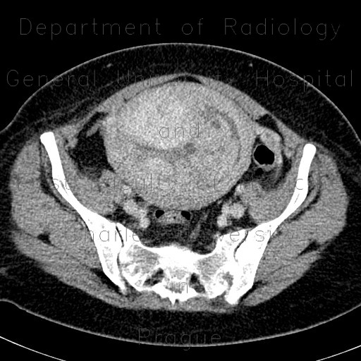 Hematometra