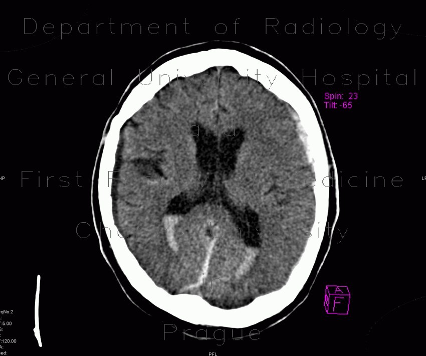 Radiology image - Hemocephalus, subarachonoid hemorrhage, subdural hematoma, brain contusion: Brain, Brain: CT - Computed tomography