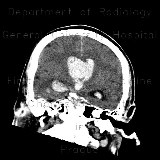 Radiology image - Hemocephalus, ventricular bleeding: Brain, Brain: CT - Computed tomography