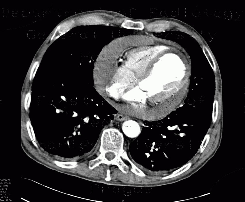 Hemopericardium