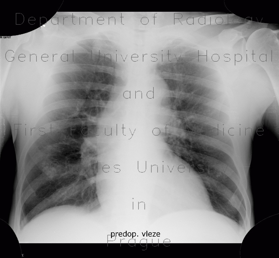 Hemopericardium, aortic valve replacement