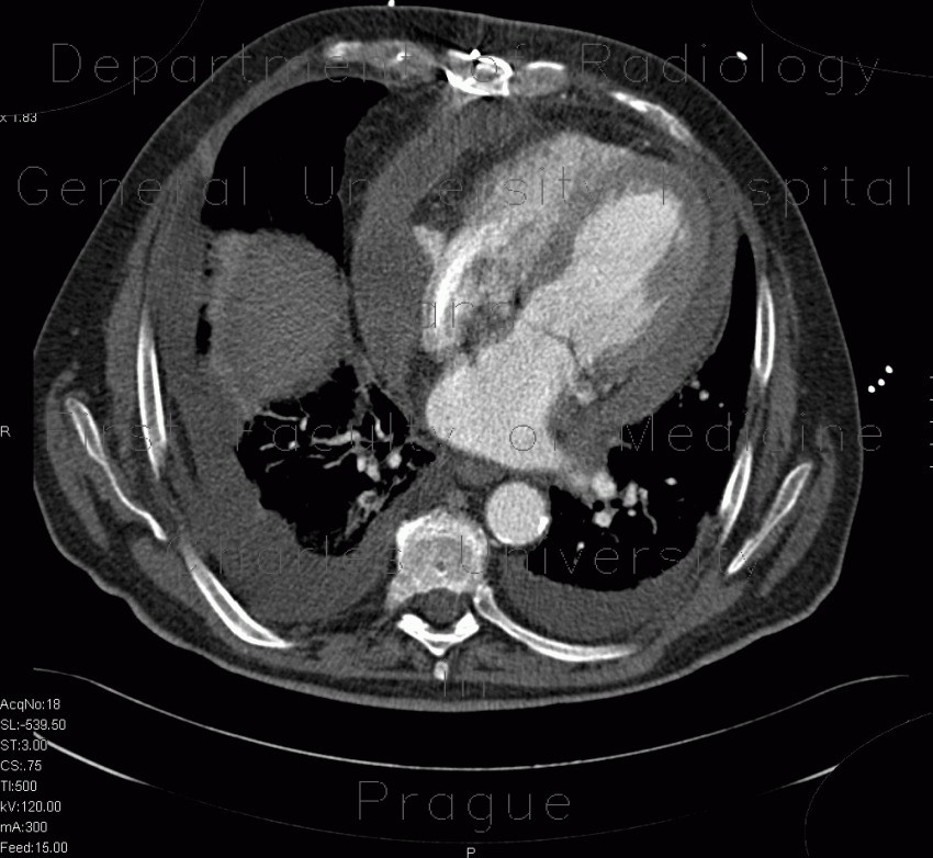 Hemopericardium, perforation of the right atrium