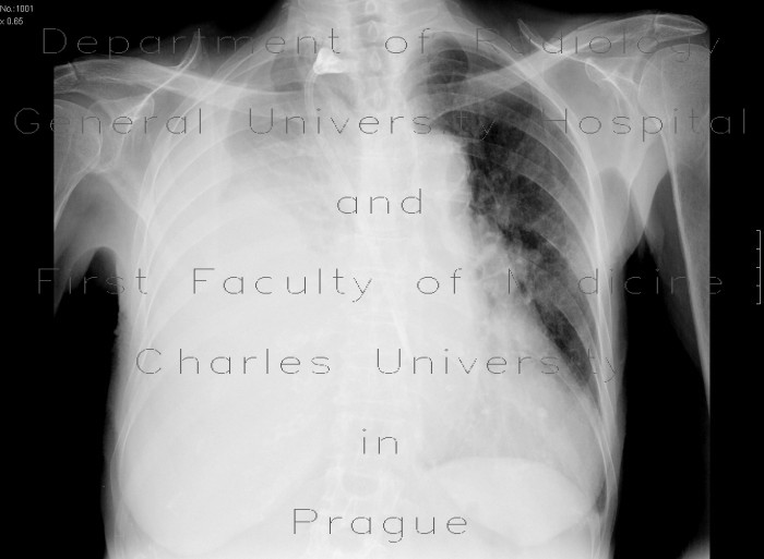 Hemothorax