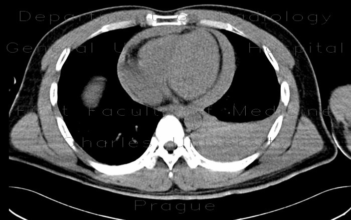 Radiology image - Hemothorax, hemopericardium: Thorax, Heart, Mediastinum and pleural cavity: CT - Computed tomography