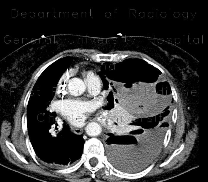 Hemothorax, pneumothorax