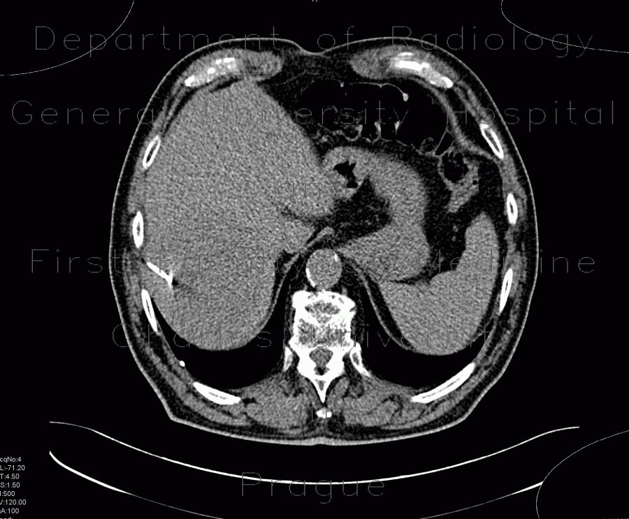 Hepatocellular adenoma, bleeding after biopsy