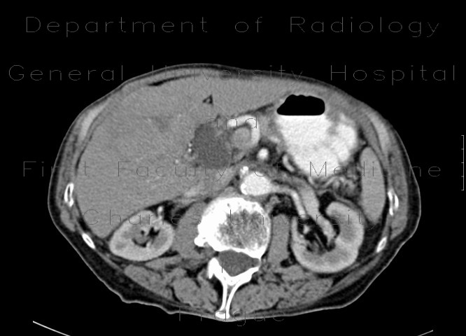 Hepatocellular carcinoma - 3 phase CT scans