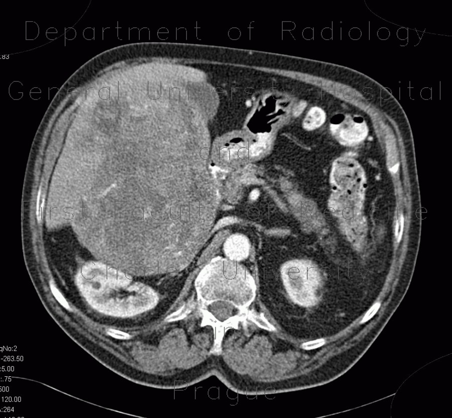 Radiology image - Hepatocellular carcinoma, HCC: Abdomen, Liver: CT - Computed tomography