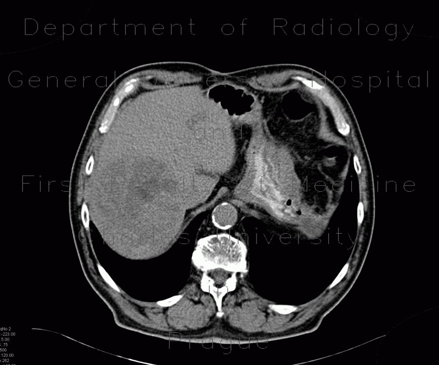 Radiology image - Hepatocellular carcinoma, HCC, gigantic: Abdomen, Liver: CT - Computed tomography