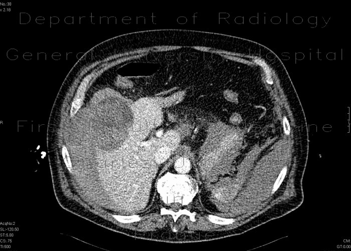 Radiology image - Hepatocellular carcinoma, ruptured, hemoperitoneum: Abdomen, Liver, Peritoneal cavity: CT - Computed tomography