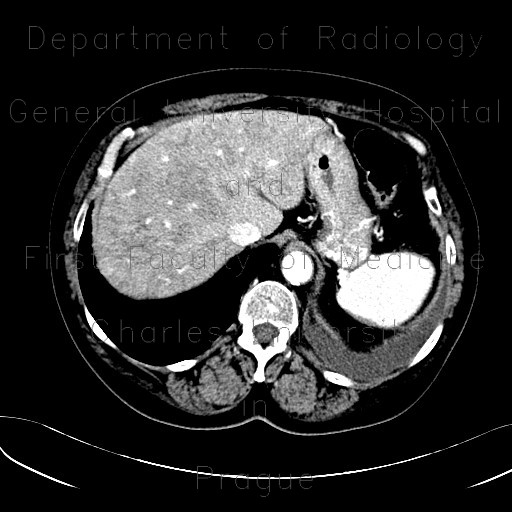 Radiology image - Hepatopathy after chemotherapy: Abdomen, Liver: CT - Computed tomography