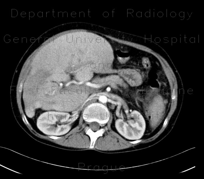 Radiology image - Hereditary hemochromatosis: Abdomen, Liver: CT - Computed tomography