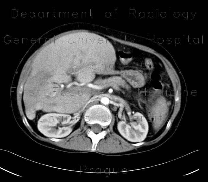 Hereditary hemochromatosis