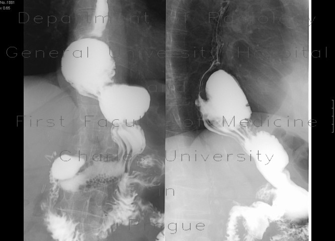 Radiology image - Hiatal hernia: Abdomen, Oesophagus, Stomach: RF - Fluoroscopy