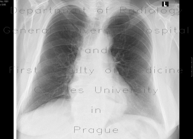 Hiatal hernia, chest radiograph