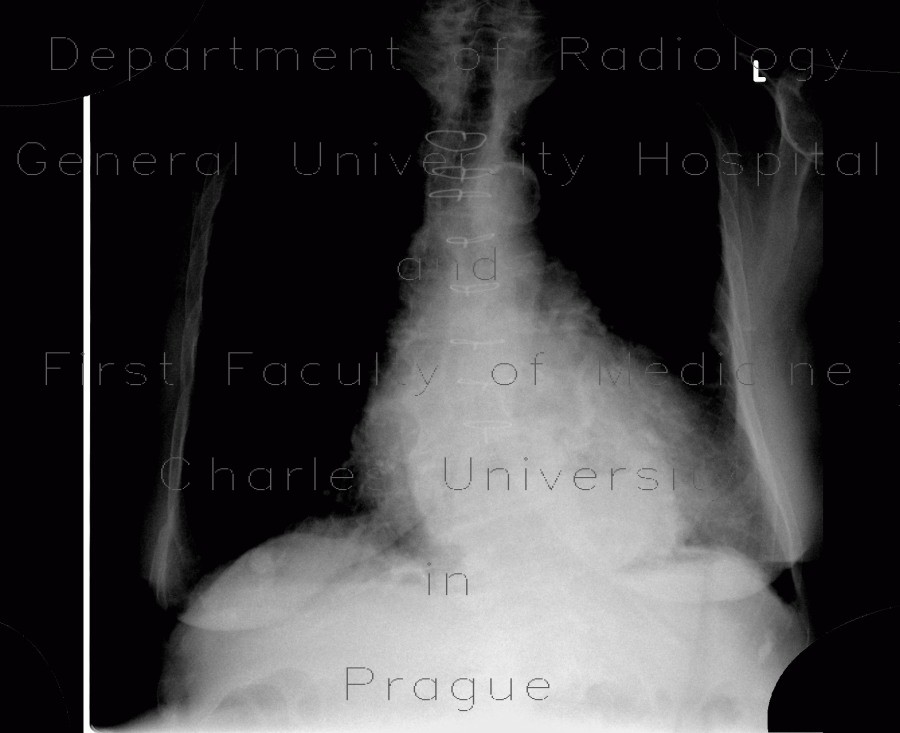 Radiology image - Hiatal hernia, chest radiograph: Thorax, Oesophagus: X-ray - Plain radiograph