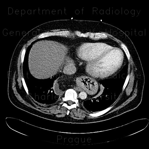 Radiology image - Hiatal hernia, mixed type, reactive fluid: Thorax, Oesophagus, Stomach: CT - Computed tomography