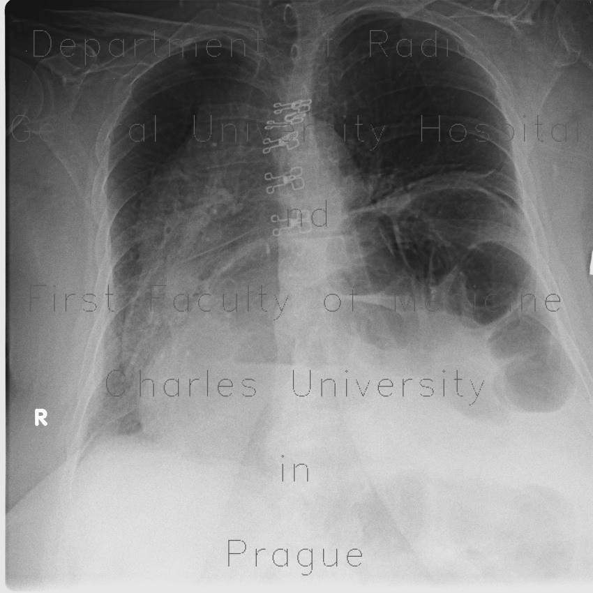 paraesophageal hernia x ray