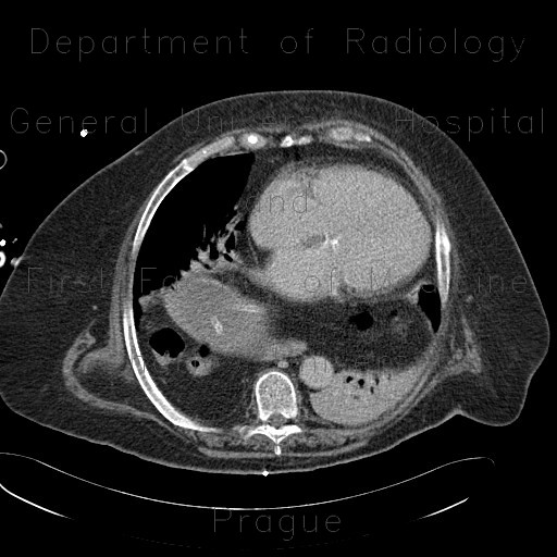 Hiatus hernia, gigantic, dyspnea