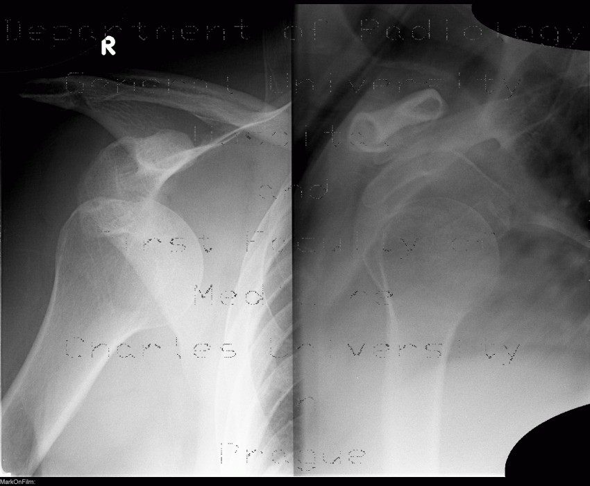 Radiology image - Hill-Sachs sign, dislocation of glenohumeral joint: Extremity, Bone: X-ray - Plain radiograph