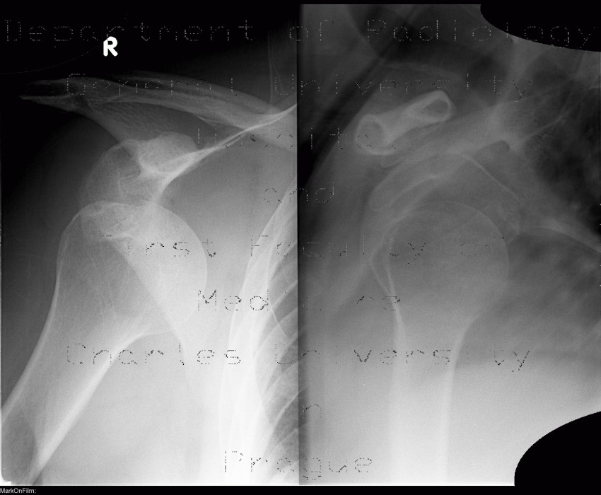 Hill-Sachs sign, dislocation of glenohumeral joint