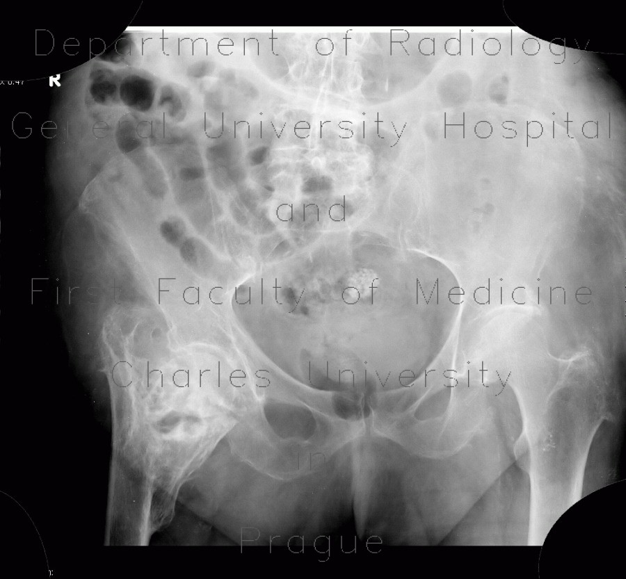Hip fracture, pertrochanteric fracture of femur, healed in dislocation