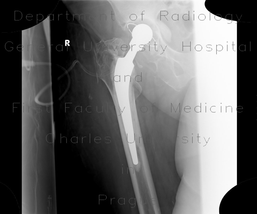 Hip replacement, cemented, leak of cement into the pelvis