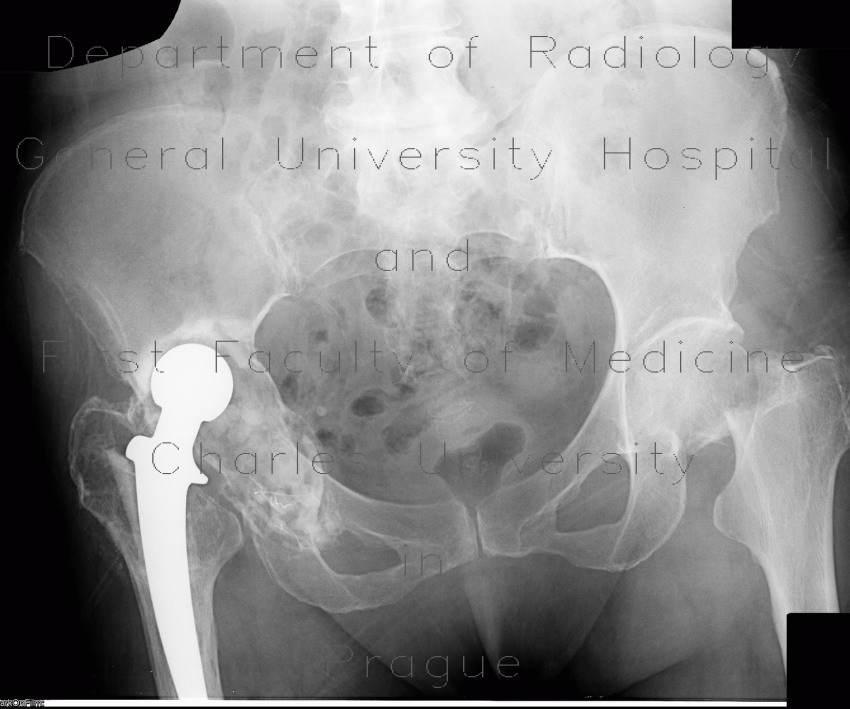 Radiology image - Hip replacement, cervical endoprosthesis, migration: Extremity, Spine and Axial, Bone: X-ray - Plain radiograph