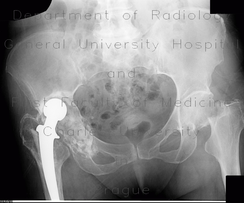 Hip replacement, cervical endoprosthesis, migration