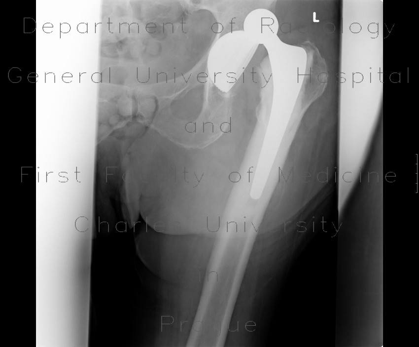 Hip replacement, dislocation