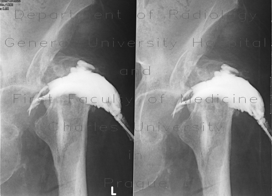 Radiology image - Hip replacement, osteomyelitis, fistula of hip joint: Extremity, Bone: X-ray - Plain radiograph