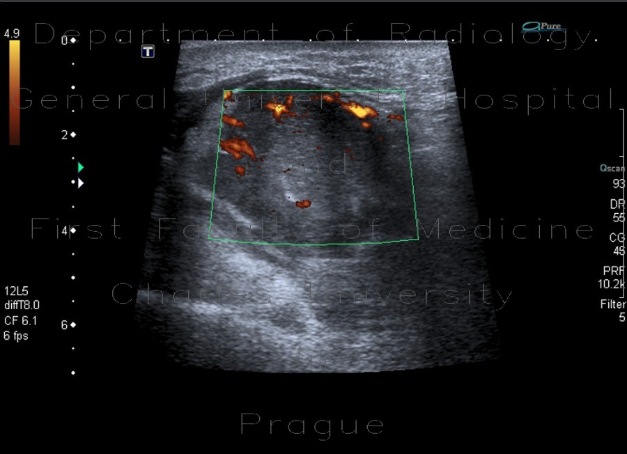 Histiocytoma, recurrence, malignant histiocytoma