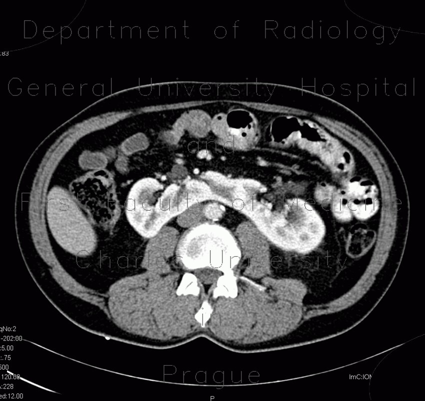 Ultrasound Horseshoe Kidney. Horseshoe kidney