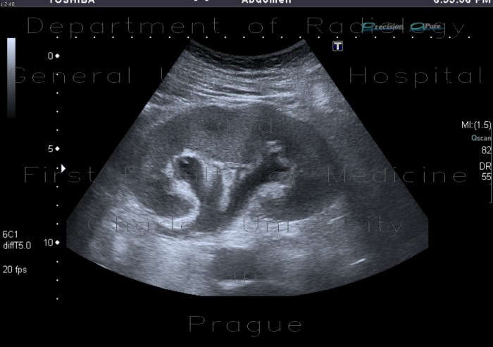 Radiology image - Hydronephrosis: Abdomen, Kidney and adrenals, Urinary tract: US - Ultrasound