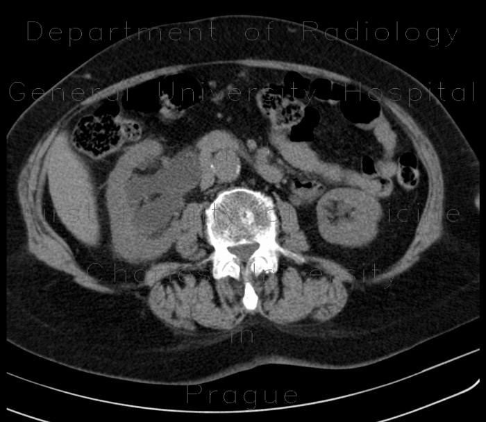 Hydronephrosis